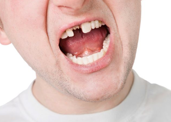 牙周病恐增掉牙風險