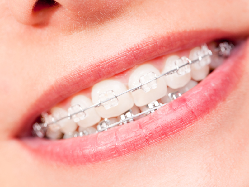 咬合不正-矯正療程-透明傳統矯正牙套-與傳統矯正牙套原理相同-但材質透明美觀