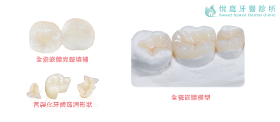 3d齒雕 陶瓷嵌體 全瓷嵌體 悅庭牙醫診所 台北牙醫推薦