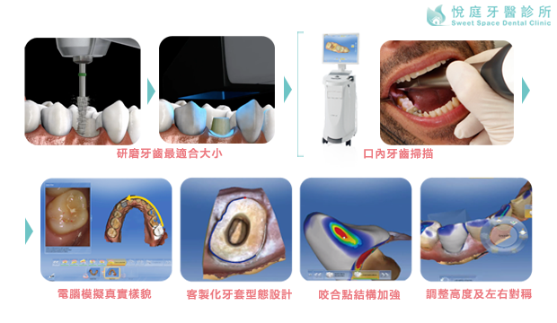 全瓷冠-全瓷牙冠-全瓷冠假牙-製作流程