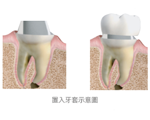 牙套-根管治療-蛀牙-全瓷冠-全瓷牙冠-全瓷冠假牙-台北-悅庭牙醫