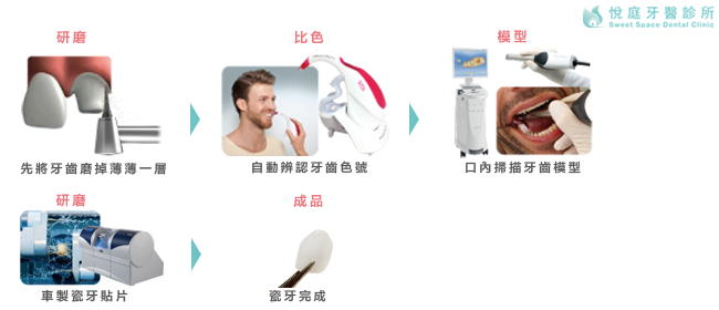 瓷牙貼片-製作流程-陶瓷貼片-牙齒美白貼片-悅庭-台北牙醫推薦