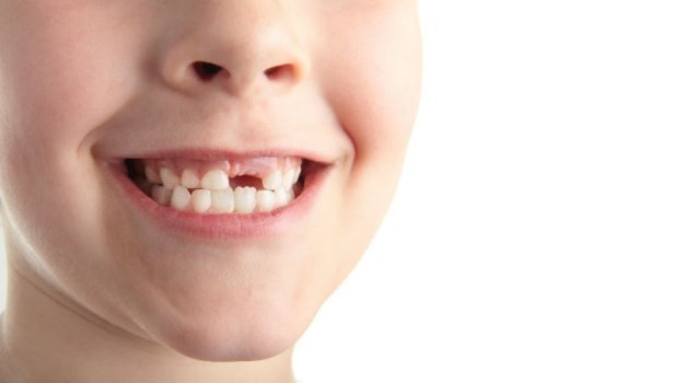 缺牙不補，竟會導致失智、跌倒風險增2.5倍！關於「缺牙」你該知道的5件事