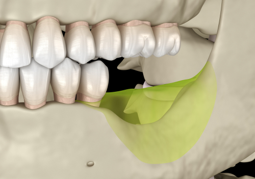 圖/長期缺牙會導致附近牙齒移位、齒槽骨萎縮等後遺症。