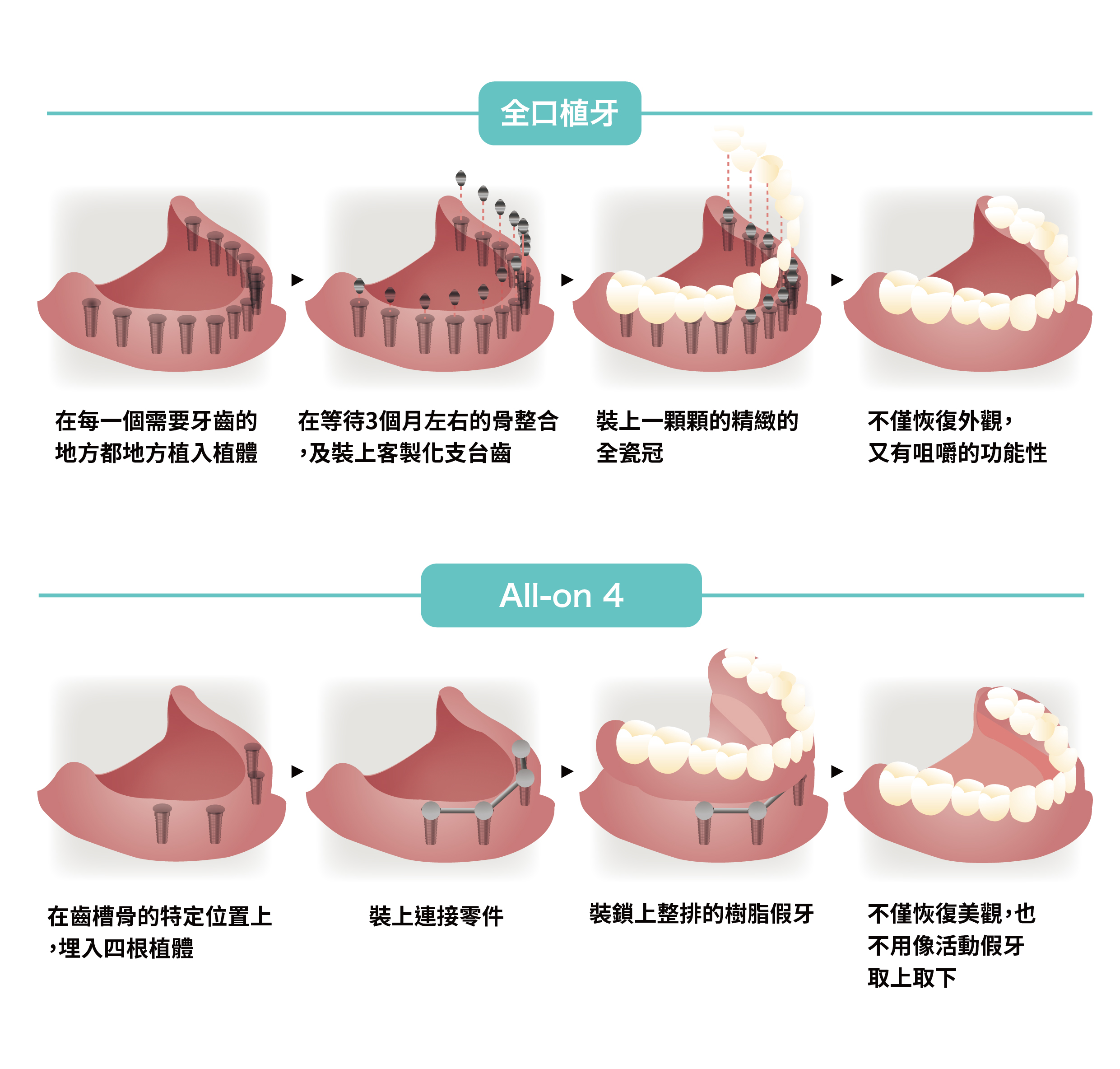 全口缺牙的煩惱 可以利用all On 4 全口快速負載假牙來重建微笑曲線 悅庭牙醫診所 台北牙醫推薦 全瓷冠 瓷牙貼片 導引式植牙 人工植牙 舒眠無痛治療