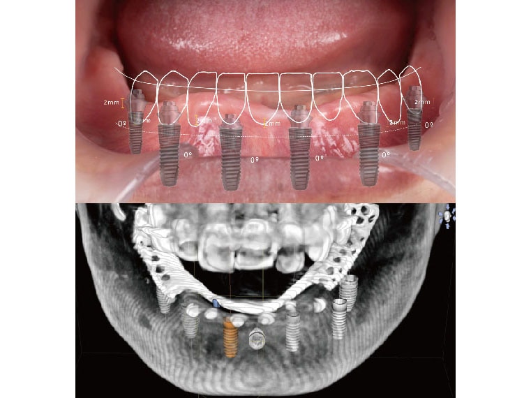 全口重建-all-on-4-植牙式固定全顎牙橋-流程-術前掃描評估-數位導引系統設計-悅庭牙醫-台北