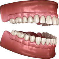 全口重建-all-on-4-植牙式固定全顎牙橋-碧歐適-悅庭牙醫-台北
