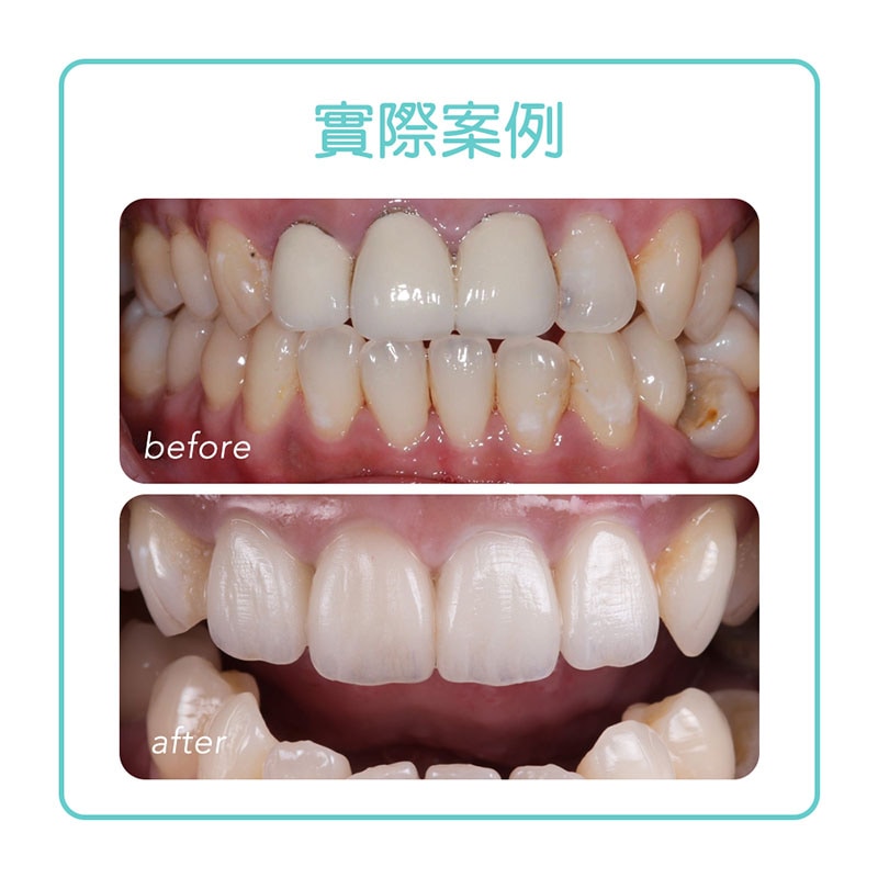 全瓷冠-一日假牙-數位假牙-全瓷冠療程前後比較-悅庭牙醫-台北