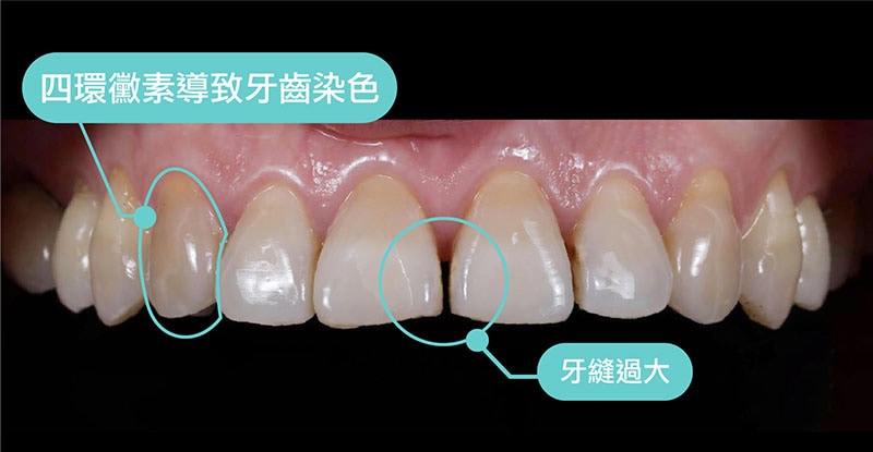 全瓷冠-四環黴素牙齒-牙縫大-牙齒美白-療程前-悅庭牙醫-台北