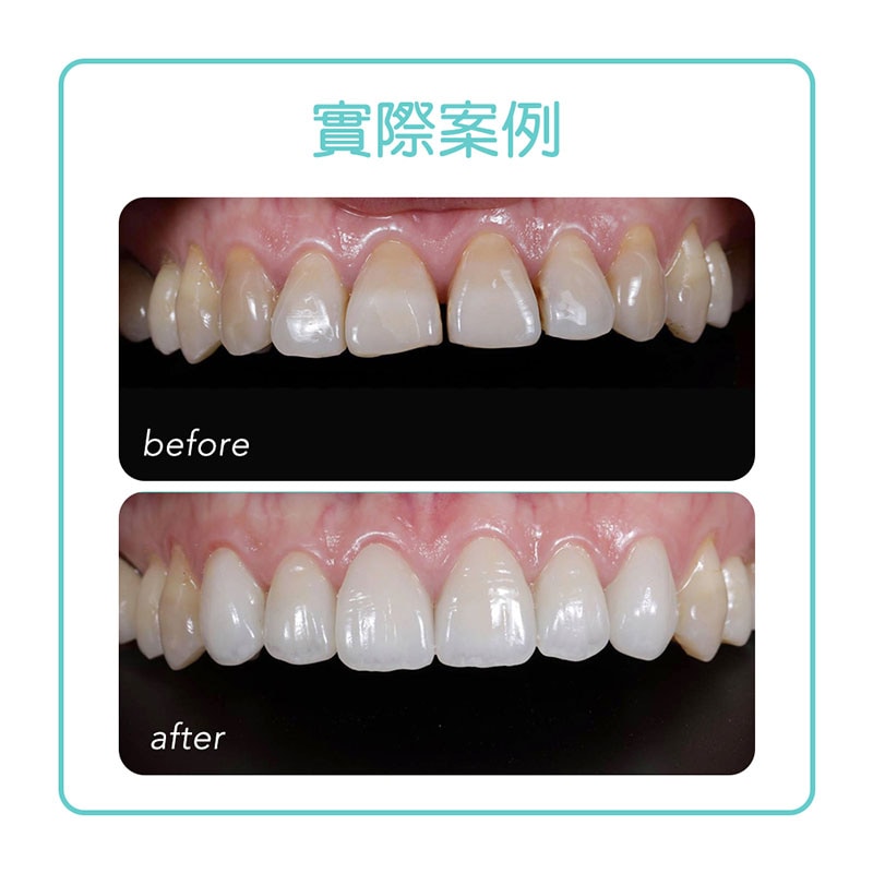 全瓷冠-四環黴素牙齒-牙縫大-牙齒美白-療程前後比較-悅庭牙醫-台北