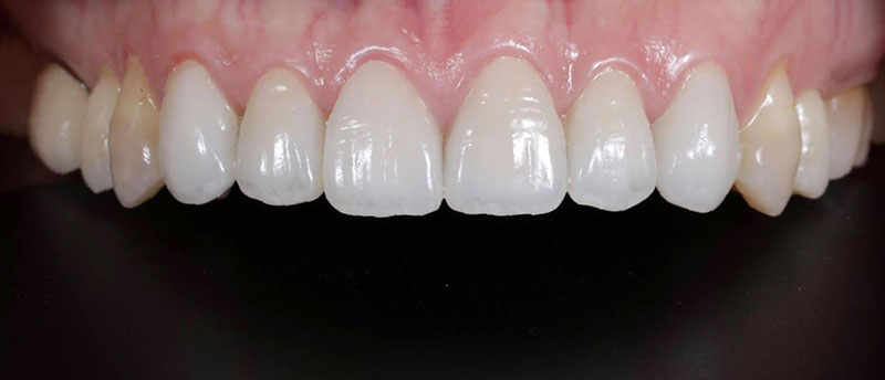 全瓷冠-四環黴素牙齒-牙縫大-牙齒美白-療程後-上排前牙-悅庭牙醫-台北