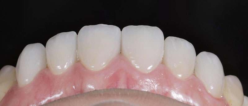 全瓷冠-四環黴素牙齒-牙縫大-牙齒美白-療程後-上排前牙形狀近照-悅庭牙醫-台北