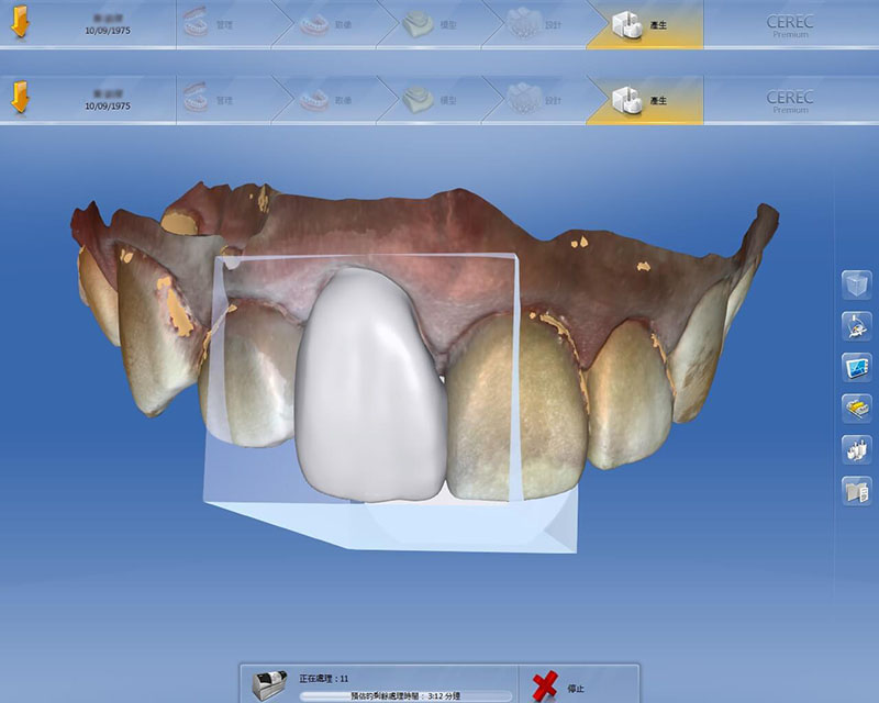 全瓷冠-導引式植牙-全瓷冠門牙-3D模擬設計圖-1-悅庭牙醫-台北