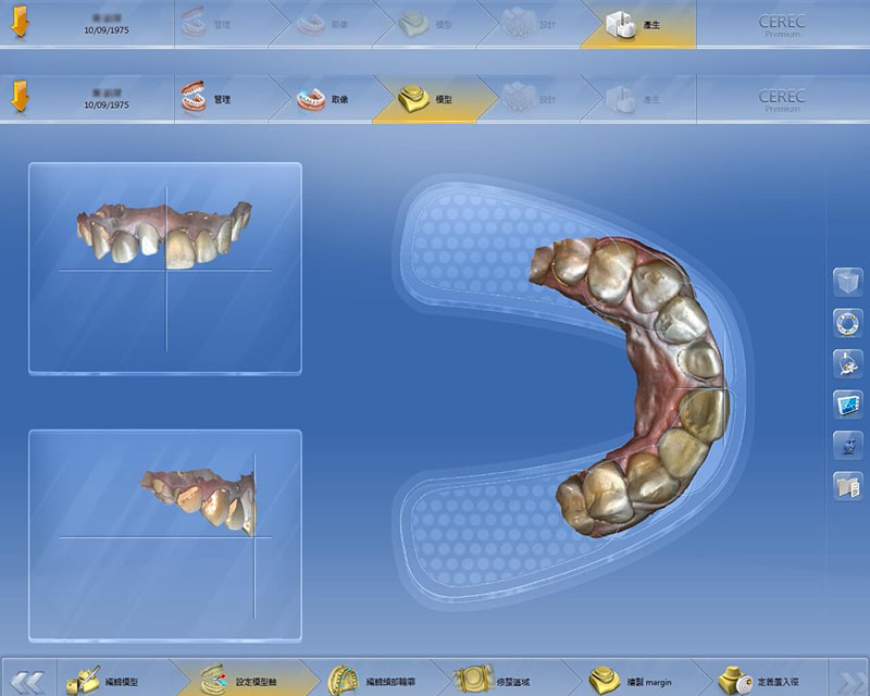 全瓷冠-導引式植牙-全瓷冠門牙-3D模擬設計圖-2-悅庭牙醫-台北
