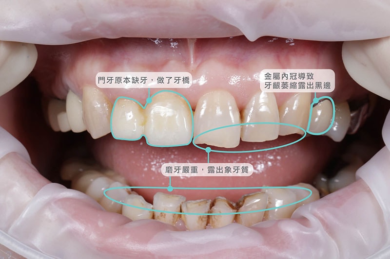 全瓷冠-導引式植牙-植牙前-假牙黑邊-牙齦萎縮-磨牙-悅庭牙醫-台北