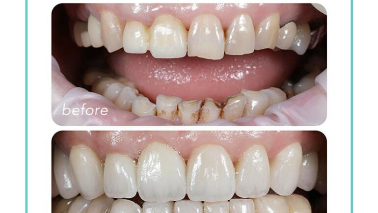 缺牙、舊假牙導致牙齦萎縮，用全瓷冠蛻變成美麗的新牙齒