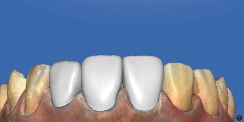 全瓷冠-根管治療牙套-假牙牙冠-數位3D模擬設計圖-悅庭牙醫-台北
