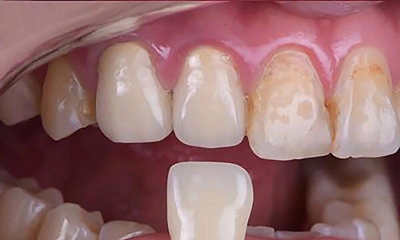 全瓷冠-根管治療牙套-假牙牙冠-牙齒比色-悅庭牙醫-台北