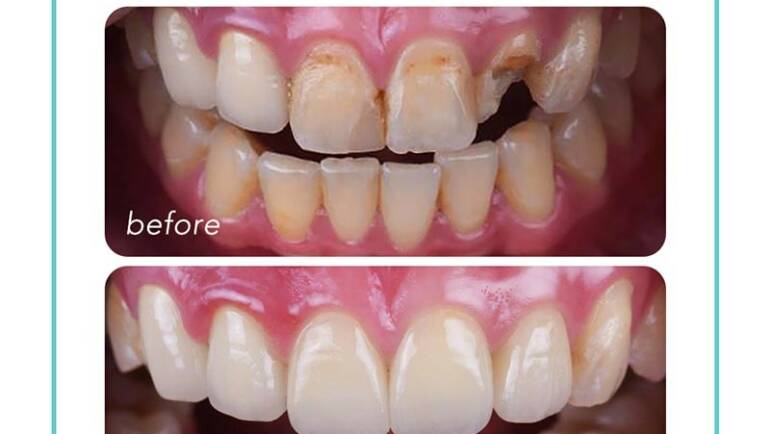 全瓷冠拯救斷裂的門牙，根管治療牙套恢復牙齒的力與美