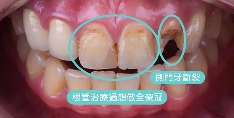 全瓷冠-治療前-門牙抽神經-根管治療-側門牙斷裂-悅庭牙醫-台北
