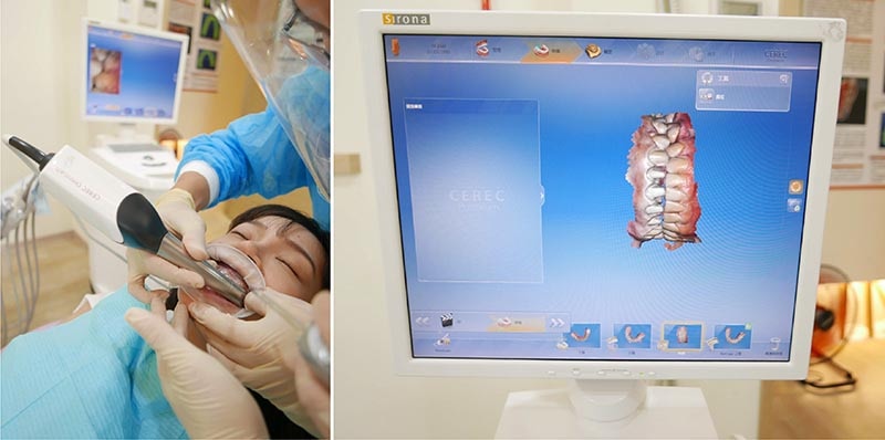 全瓷冠-瓷牙貼片-DSD微笑設計-數位口腔掃描-全瓷冠設計-悅庭牙醫-台北