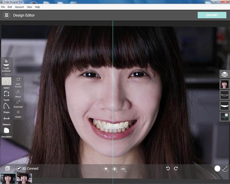 全瓷冠-瓷牙貼片-DSD微笑設計-模擬術後狀況-悅庭牙醫-台北
