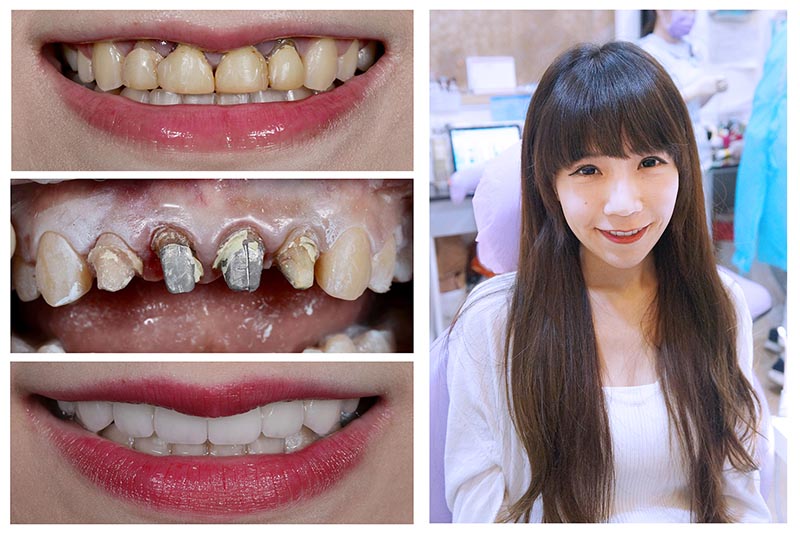 全瓷冠-瓷牙貼片-DSD微笑設計-療程前中後照片-悅庭牙醫-台北