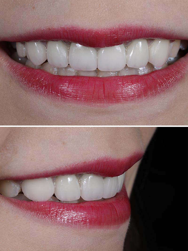 全瓷冠-瓷牙貼片-DSD微笑設計-療程後牙齒近照-悅庭牙醫-台北