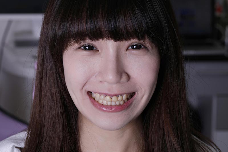 全瓷冠-瓷牙貼片-療程前-原有假牙-牙齒貼片-悅庭牙醫-台北