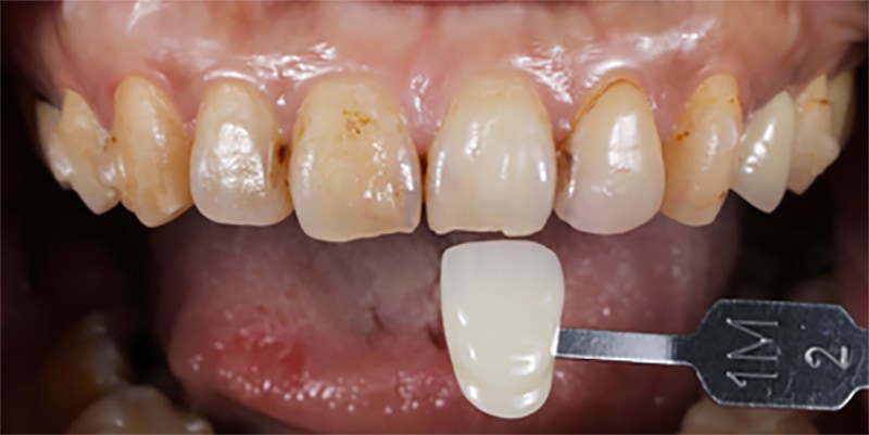 全瓷冠-瓷牙貼片-療程前-牙齒比色-悅庭牙醫-台北