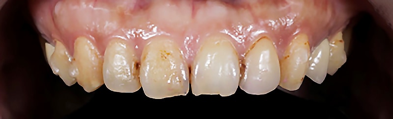 全瓷冠-瓷牙貼片-療程前-牙齒變色-牙齒磨耗-咬合不正-牙縫大-悅庭牙醫-台北