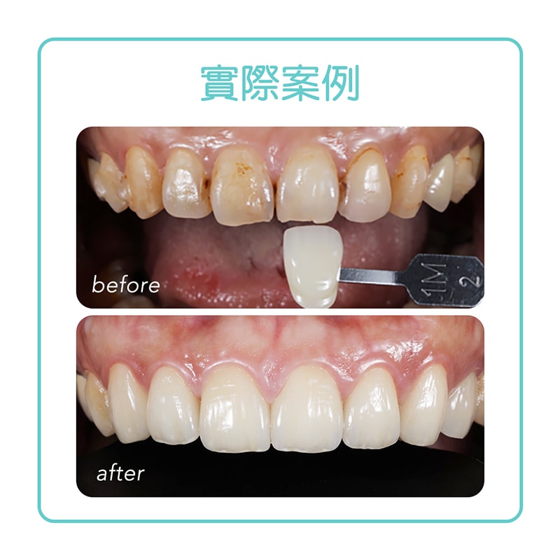 全瓷冠-瓷牙貼片-療程前後比較-悅庭牙醫-台北