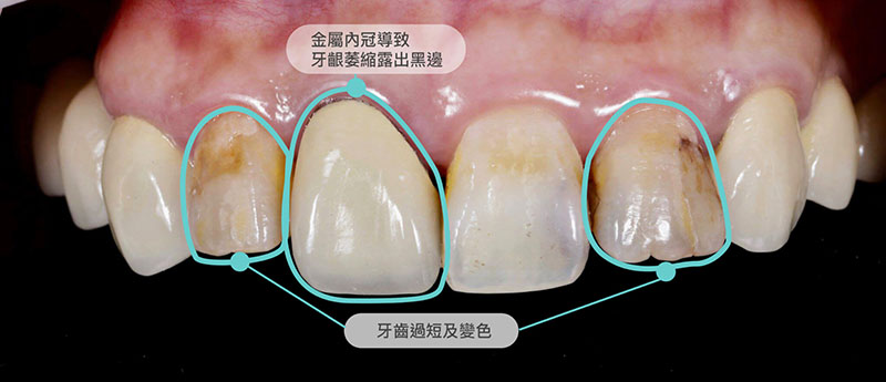 全瓷冠-療程前-金屬牙冠-假牙牙齦黑-牙齒短-悅庭牙醫-台北