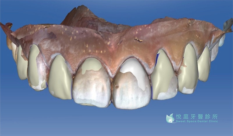 全瓷冠價格-全瓷冠流程-數位口掃機-3D牙齒模型-悅庭牙醫-台北