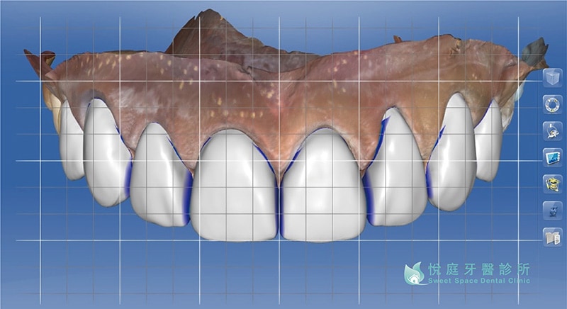 全瓷冠價格-全瓷冠流程-數位口掃機-全瓷冠門牙3D模型-悅庭牙醫-台北