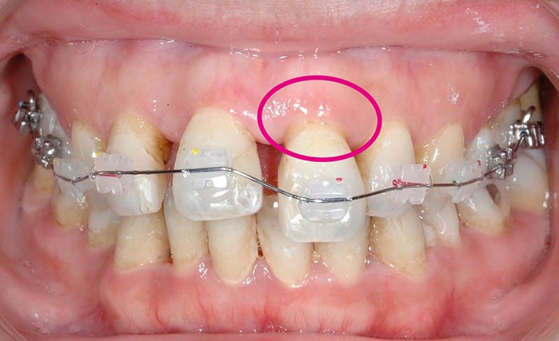 嚴重牙周病-牙齦萎縮-牙根外露-牙齒矯正中-悅庭牙醫-台北
