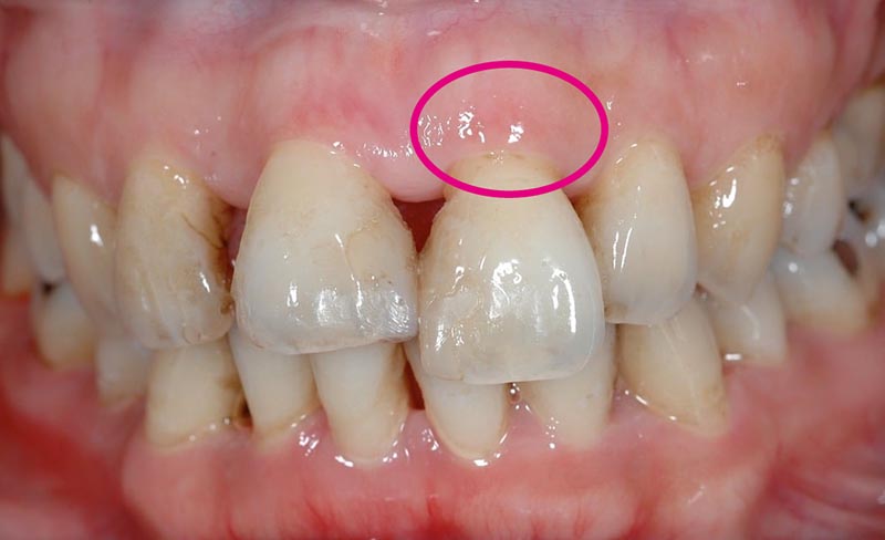 嚴重牙周病-牙齦萎縮-牙根外露-牙齒矯正前-悅庭牙醫-台北