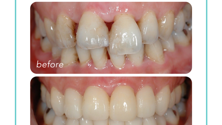 嚴重牙周病治療後，牙齦萎縮、牙縫大的改善方法
