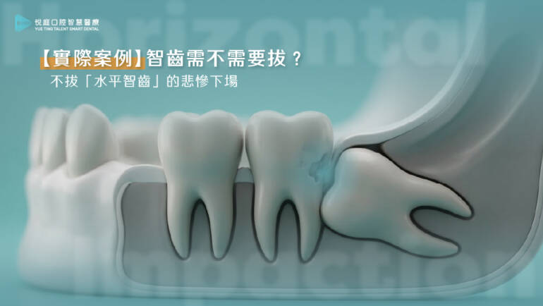 【實際案例】智齒需不需要拔？不拔「水平智齒」的悲慘下場