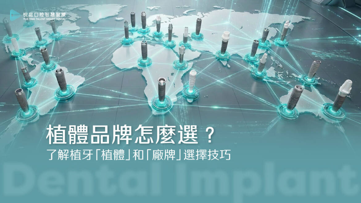 植體品牌怎麼選？了解植牙「植體」和「廠牌」選擇技巧