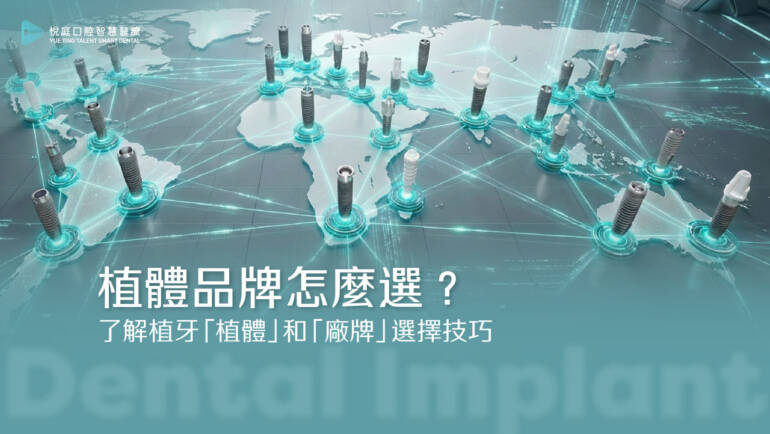 植體品牌怎麼選？了解植牙「植體」和「廠牌」選擇技巧