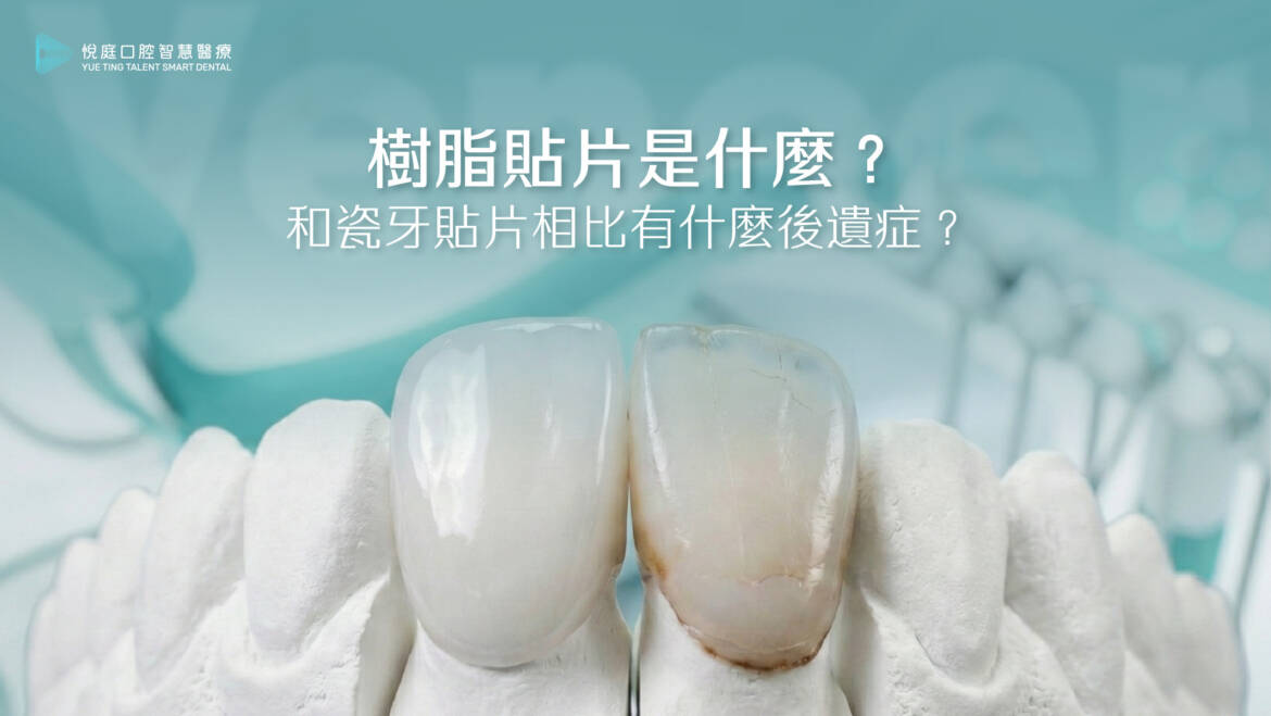 樹脂貼片是什麼？和瓷牙貼片相比有什麼後遺症？