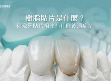 樹脂貼片是什麼？和瓷牙貼片相比有什麼後遺症？
