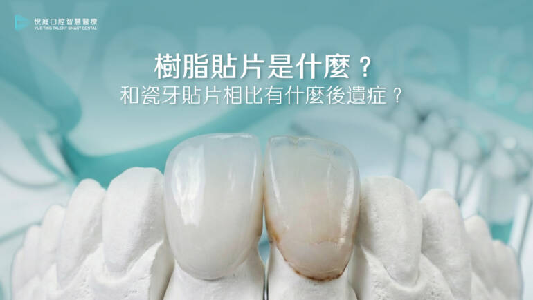 樹脂貼片是什麼？和瓷牙貼片相比有什麼後遺症？