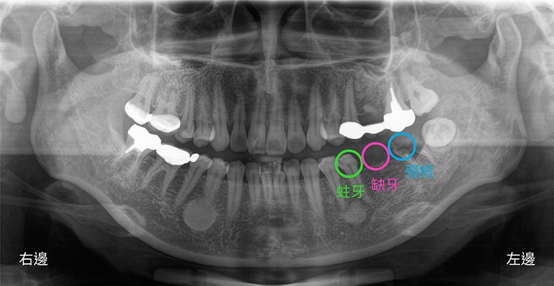 導引式植牙-全口X光片-後牙臼齒缺牙-殘根-蛀牙-悅庭牙醫-台北植牙