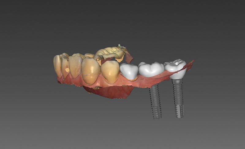 導引式植牙-全瓷冠-3D模擬圖-1-悅庭牙醫-台北植牙