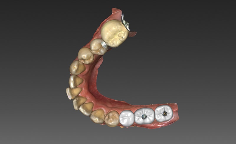 導引式植牙-全瓷冠-3D模擬圖-2-悅庭牙醫-台北植牙