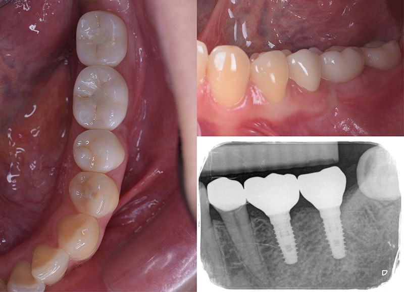 導引式植牙-全瓷冠-人工植牙-術後牙齒近照與X光-悅庭牙醫-台北植牙
