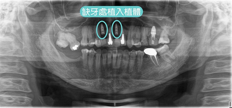 導引式植牙-全瓷冠-植入植體-環口X光片-悅庭牙醫-台北植牙