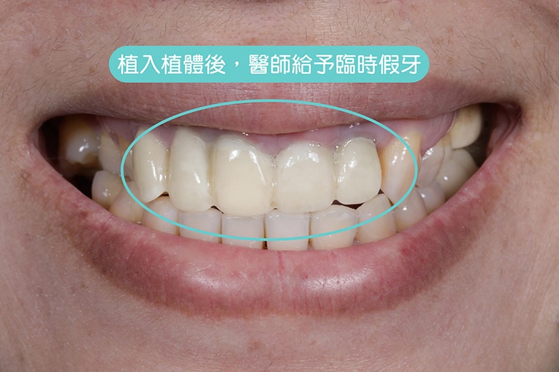 導引式植牙-全瓷冠-植入植體-臨時假牙-悅庭牙醫-台北植牙